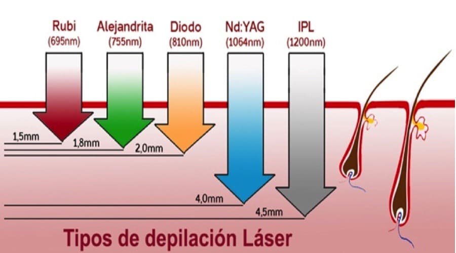 Comparativa de penetración por tipo de láser: Rubí 1.5mm, Alejandrita 1.8mm, Diodo 2mm, Nd:YAG 4mm, IPL 4.5mm