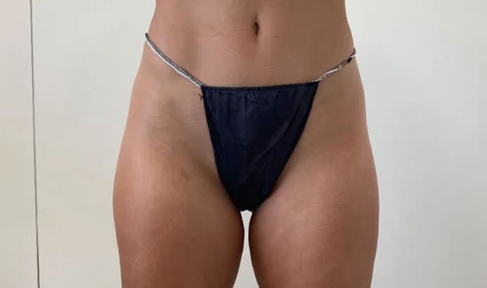 Después del ciclo completo Body Shock Mesoestetic